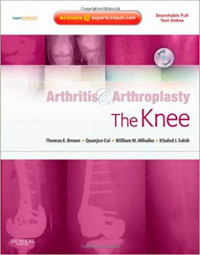 Arthritis & arthroplasty: the knee