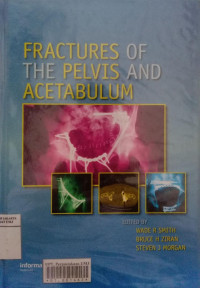 Fractures of the pelvis and acetabulum